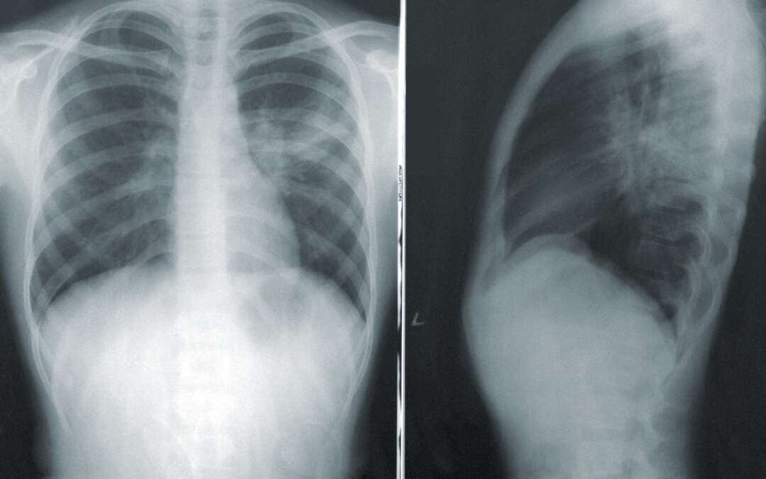 Deciding about lung cancer screening